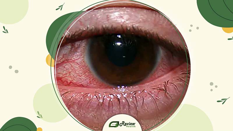 What Is an Eye Infection?
