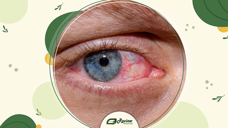 Dry Eye Symptoms