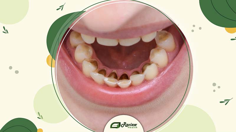 Common Symptoms of Black Teeth