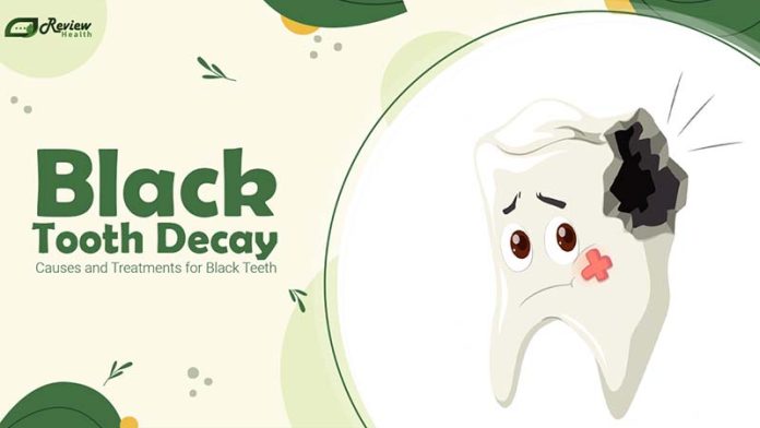 Black Tooth Decay: Causes and Treatments for Black Teeth