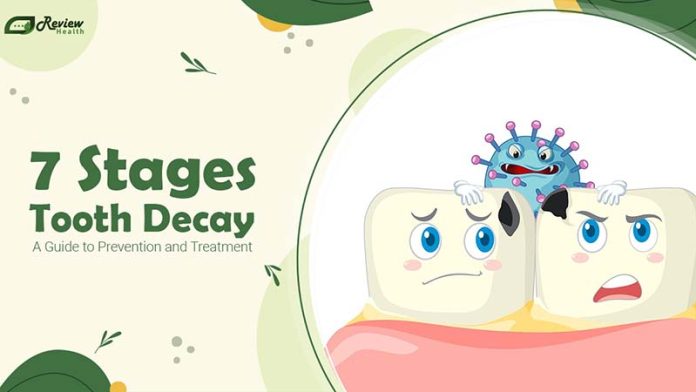 7 Stages of Tooth Decay: A Guide to Prevention and Treatment