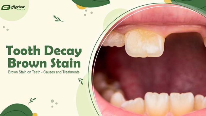 Exploring 12 Major Causes of Tooth Decay Brown Stain on Teeth You Should Know