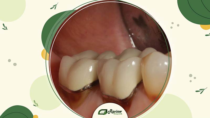 What Is Tooth Decay Under Dental Crown?