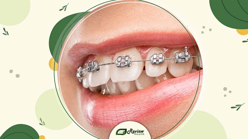 Using Braces for Teeth Alignment