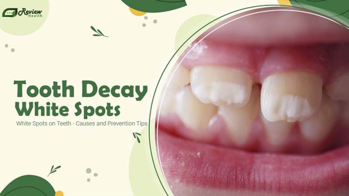 Tooth Decay: White Spots on Teeth - Causes and Prevention Tips
