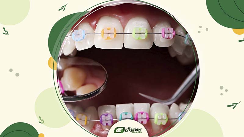 Knowing the Signs of Tooth Decay With Braces