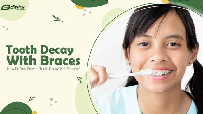 Knowing the Signs of Tooth Decay With Braces