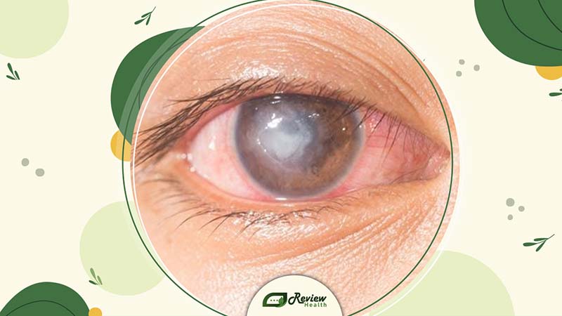 What Causes Itchy Eyes?