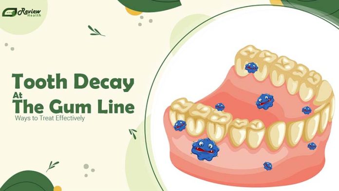 How to Treat Tooth Decay at the Gum Line: Causes and Prevention