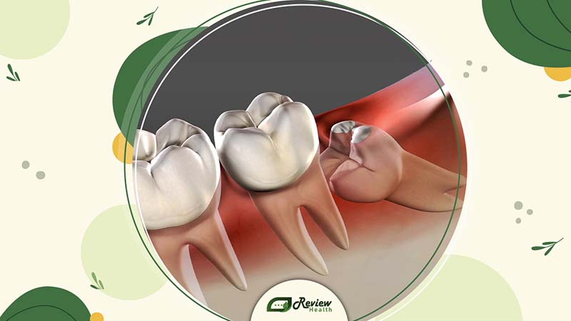 What Is a Wisdom Tooth?